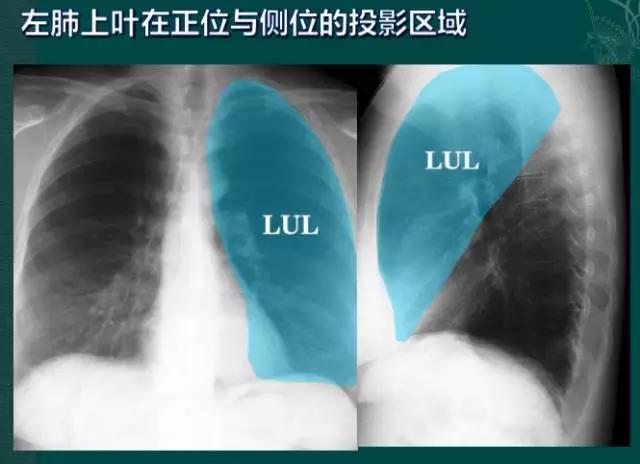 拿到胸片卻不會看?送你7個竅門,手把手教你解讀胸片