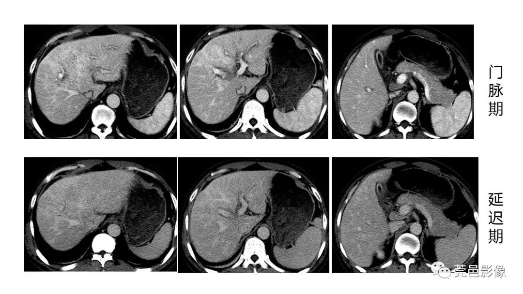 肝内门静脉周围间隙增宽影像学表现及意义