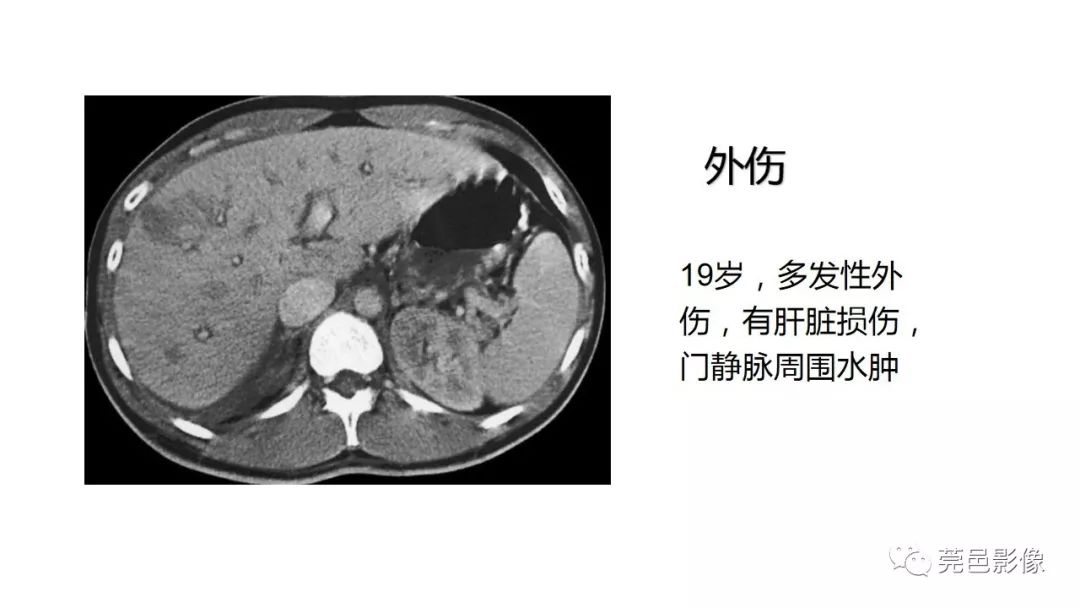肝内门静脉周围间隙增宽影像学表现及意义