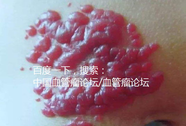 血管瘤患儿家长注意:要慎重使用激光治疗