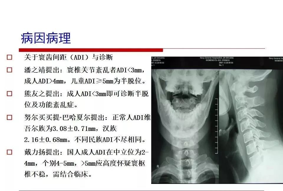 怪病之源——寰樞關節錯位_頸椎