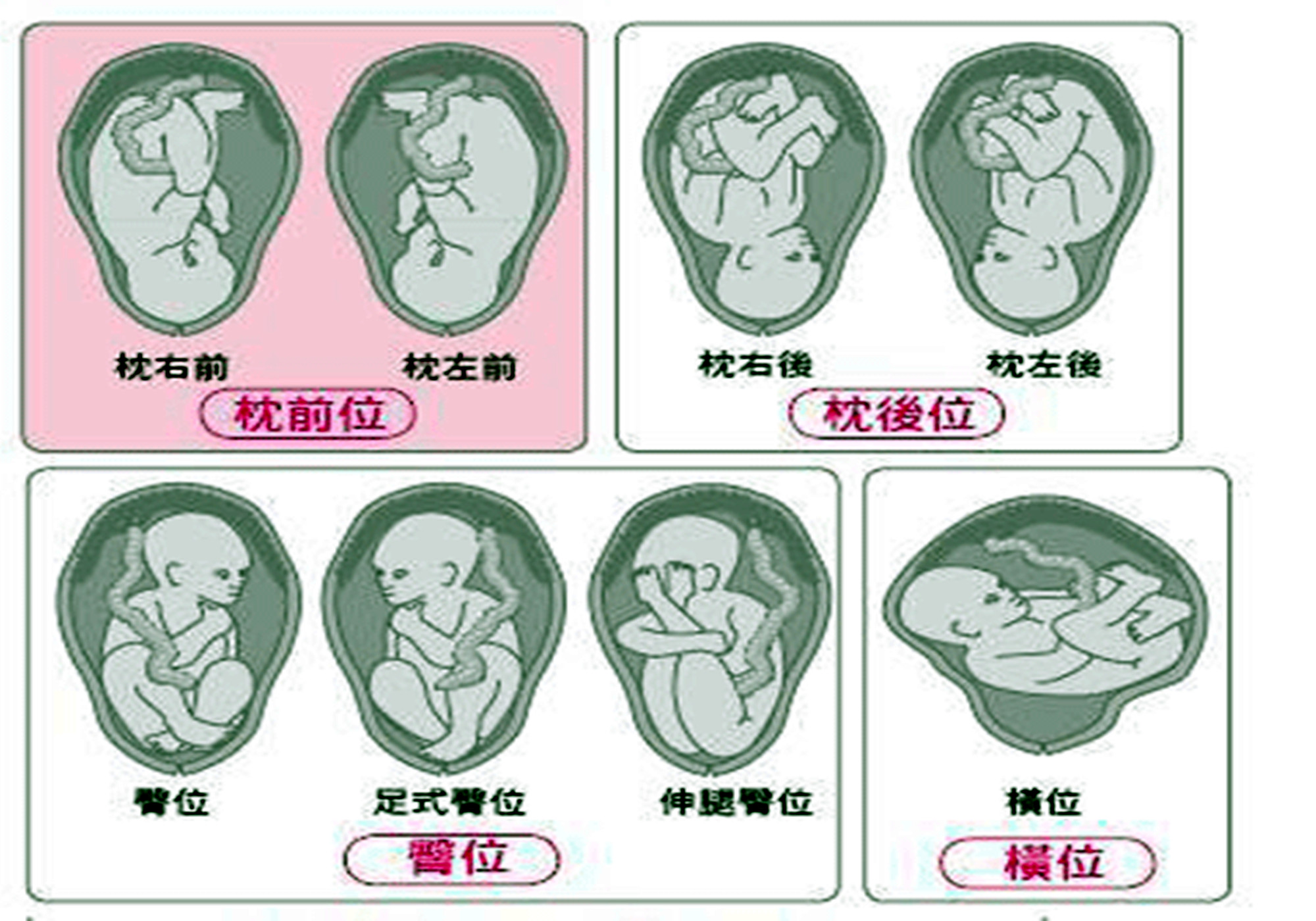 左枕后位可以顺产吗图片