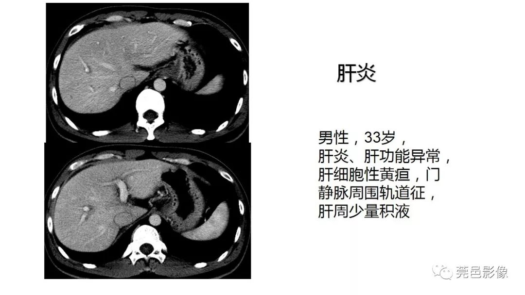 肝门静脉ct图片