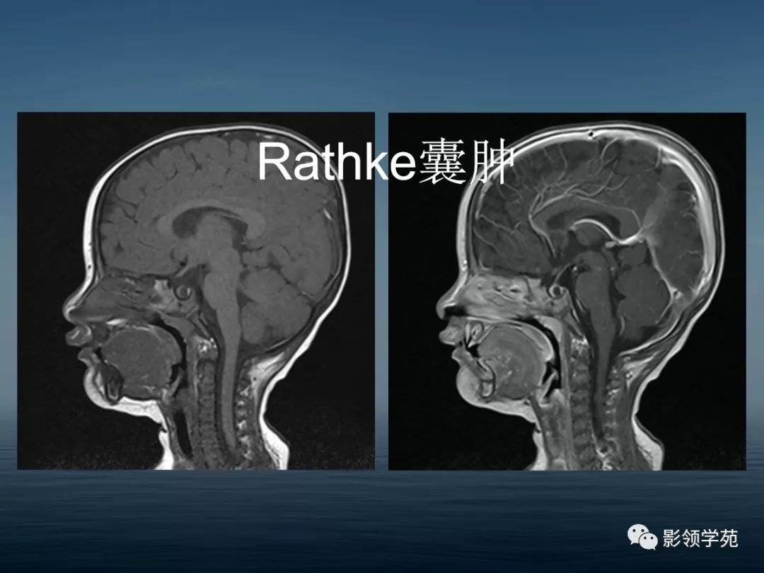 鞍区病变的ctmri诊断