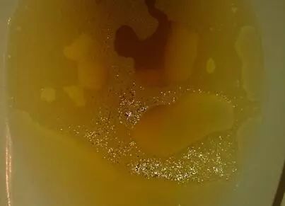 肾脏问题没小事,这8个危险信号要牢记!_尿液