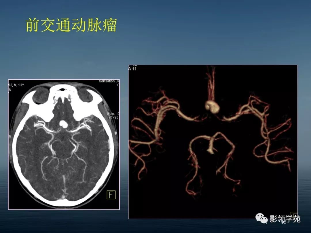 鞍区病变的ctmri诊断