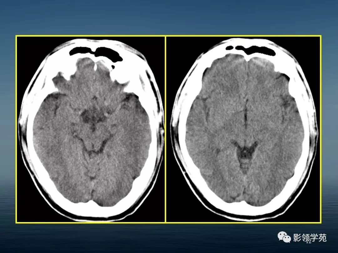 鞍区病变的ctmri诊断