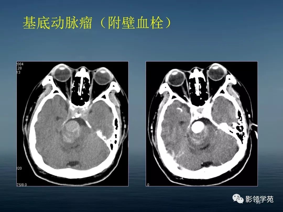 鞍区病变的ctmri诊断