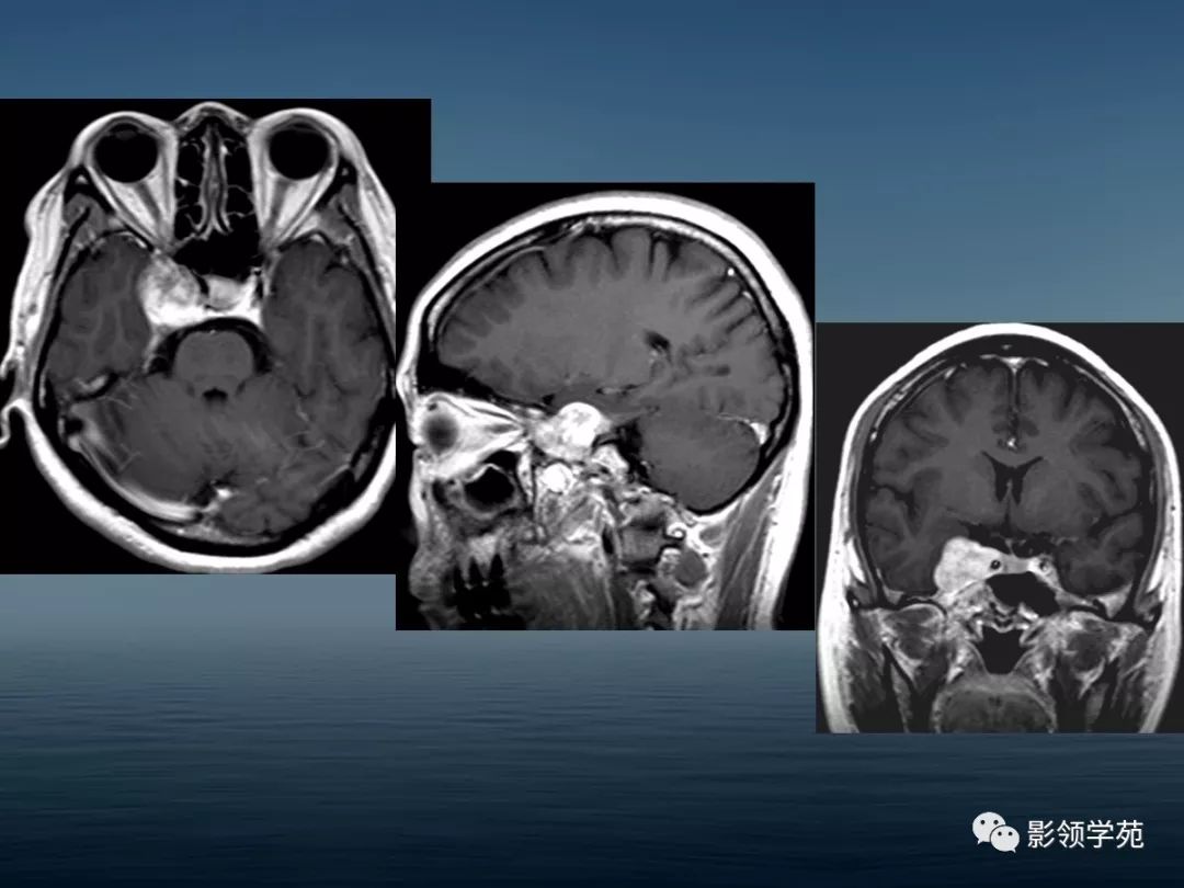鞍区病变的ctmri诊断