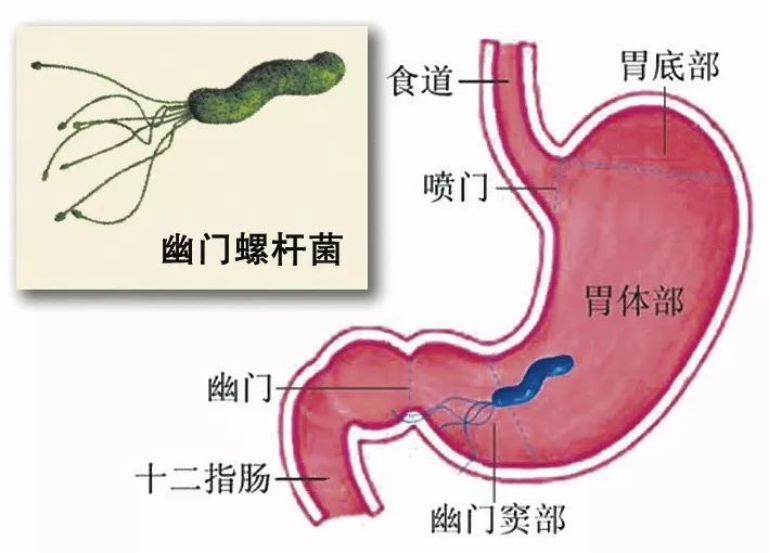 查出幽门螺旋杆菌阳性