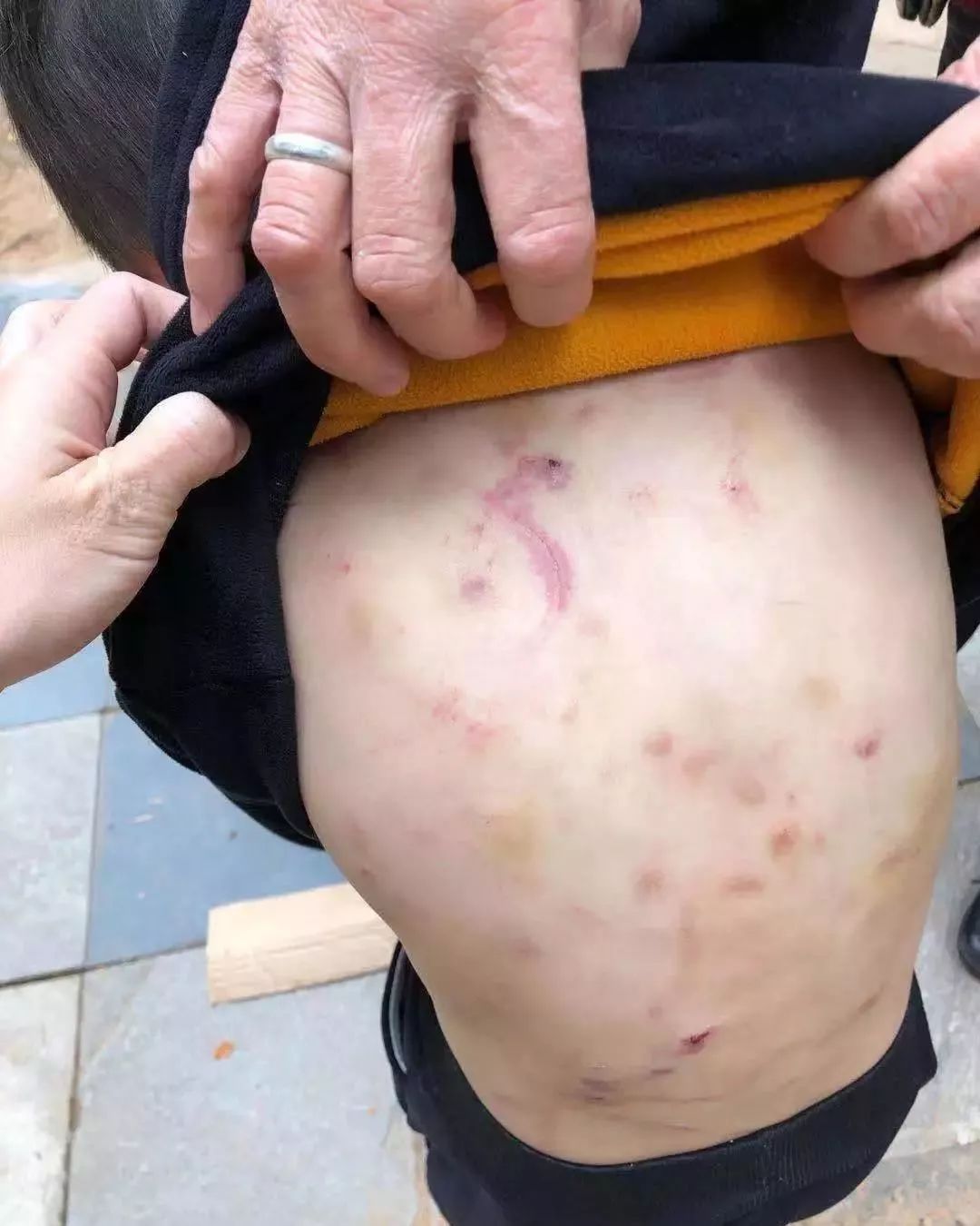 心疼!爸爸把5岁儿子打得遍体鳞伤,只因为…|新闻日志