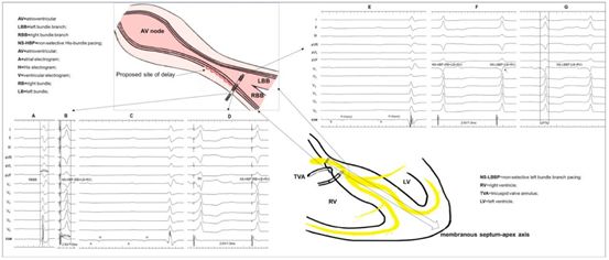 阜外医院华伟等新方法改进希氏束起搏技术