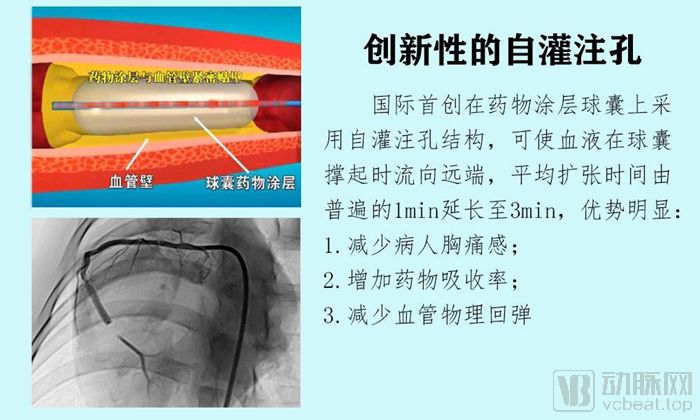 【首发】恒升医疗完成4000万元pre-a轮融资,自灌注药物洗脱球囊将于上