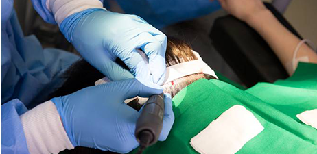 植发手术的疼痛要怎么缓解?_麻醉