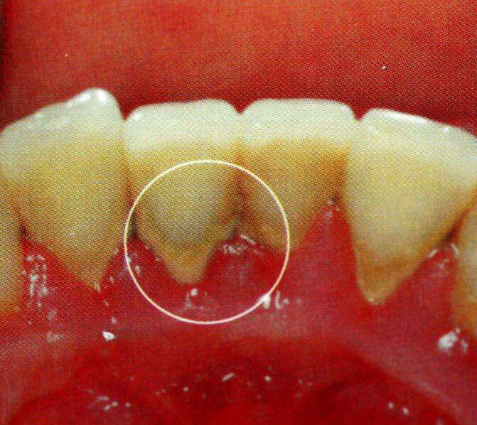 牙龈萎缩程度图片