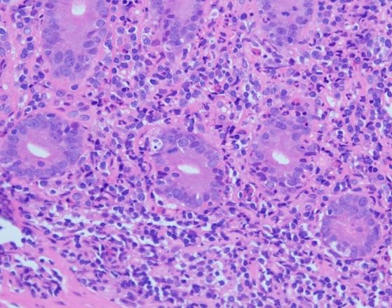 反复腹泻,需警惕自身免疫性肠炎_细胞