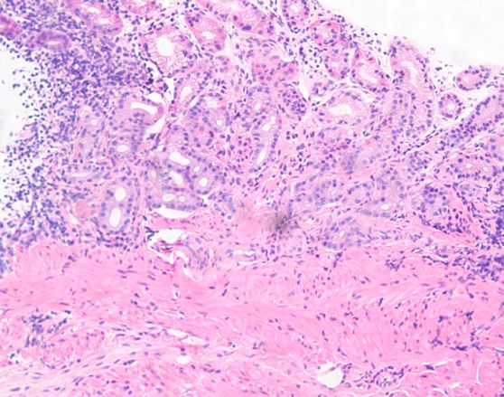 反复腹泻,需警惕自身免疫性肠炎_细胞