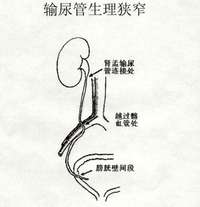 看上图,我们会发现,人体的输尿管存在生理性狭窄,正常情况下在三毫米