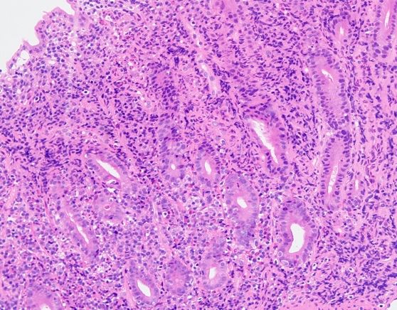 反复腹泻,需警惕自身免疫性肠炎_细胞