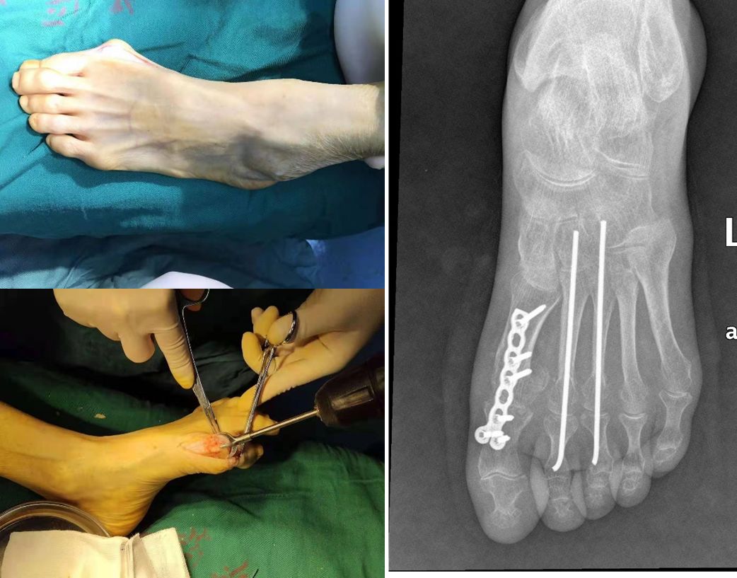 跟骨骨折钢板固定图片图片