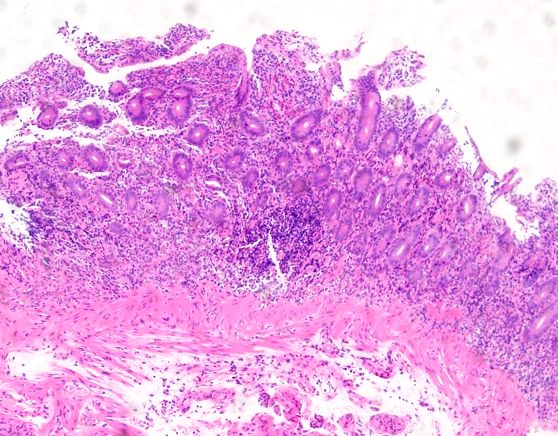 反复腹泻,需警惕自身免疫性肠炎_细胞
