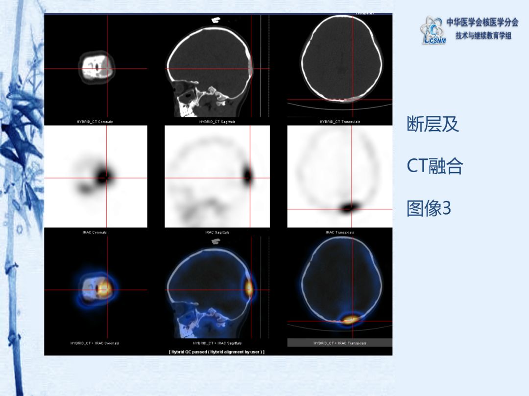 【病例】68期:肖茜 | 小儿spect骨显像一例_缪蔚冰