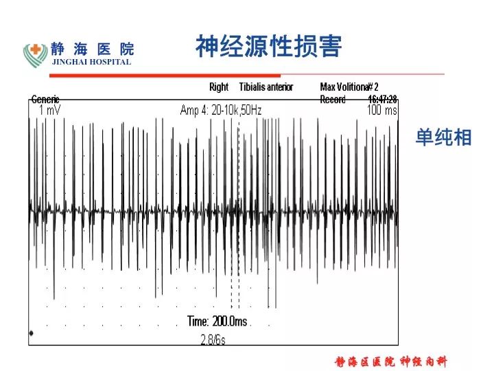 广泛神经源性损害=als?_电位