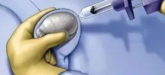 采用靶向注射种植技术,将活性细胞准确种植在男性阴茎海绵体