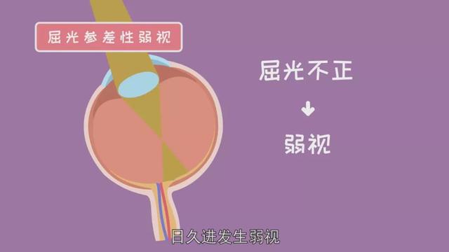 柯来视科普|儿童弱视了解一下