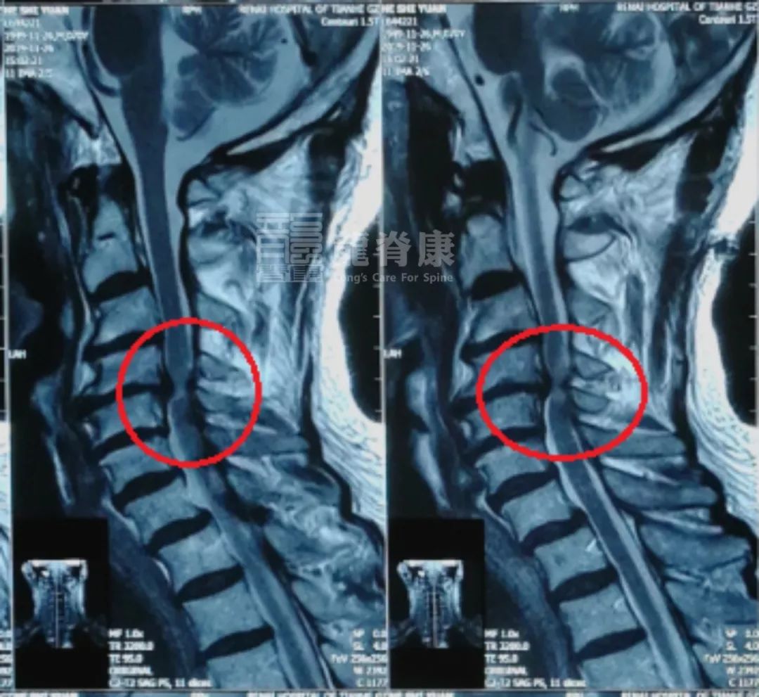 脊髓型颈椎病症状图片