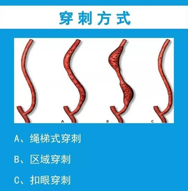 绳梯式穿刺法(rope ladder cannulation)是在一段较长血管上选取4~6个