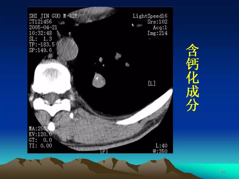 肺错构瘤影像表现及鉴别诊断
