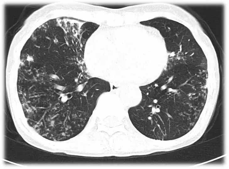 ct秒杀肺真菌感染与各类感染的鉴别