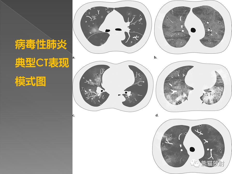 必看一例新型冠状病毒感染的肺炎ct表现