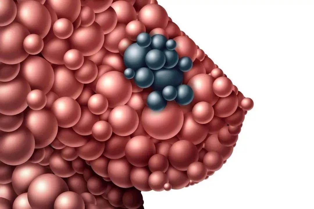 95%女性患有乳腺结节:千万别拖,否则恶性结节癌变_乳房