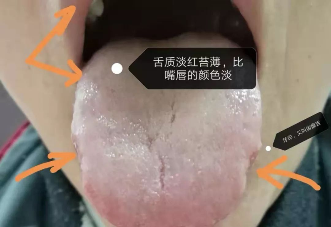 则汗出,胸闷气短,萎靡不振,脾胃虚弱,腰酸腿软,大便溏薄,苔薄舌质淡胖