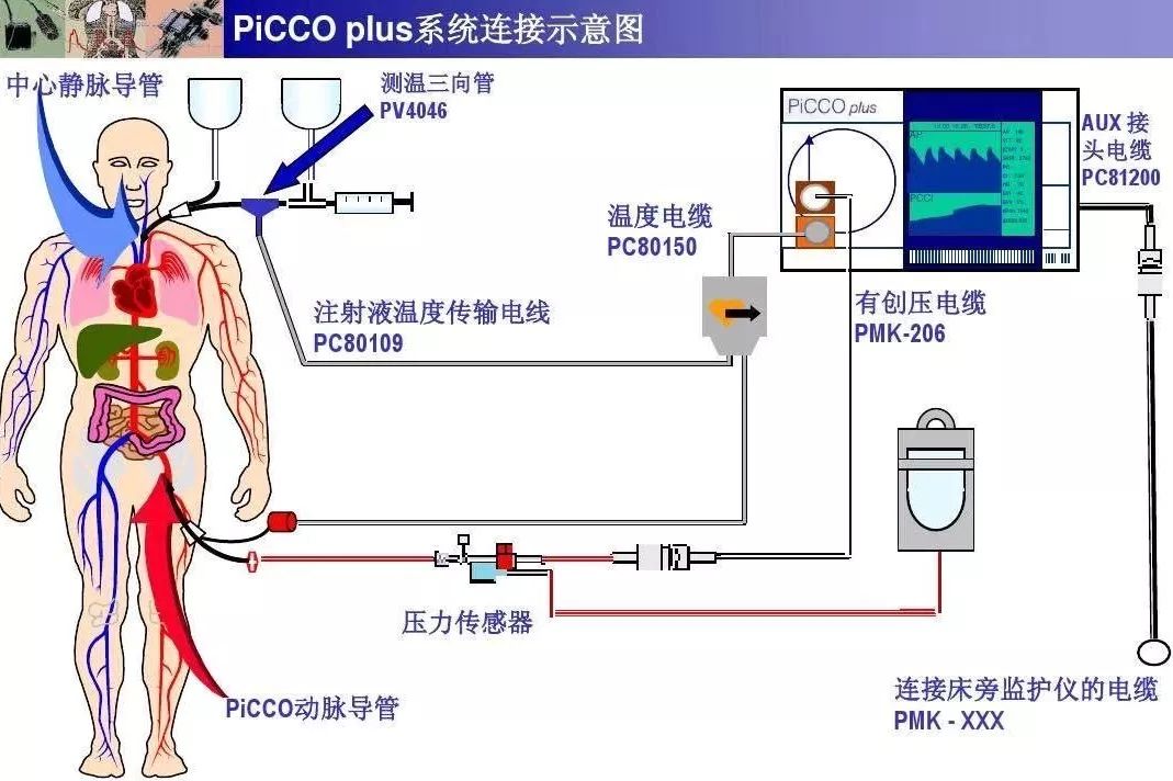 三院动态我院成功开展首例picco监测技术