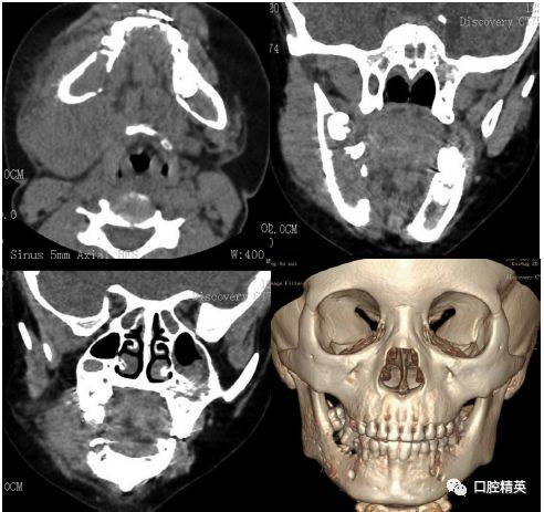 頜骨及上頜竇burkitt淋巴瘤1例報告及文獻複習