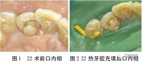 上颌侧切牙开髓位置图片