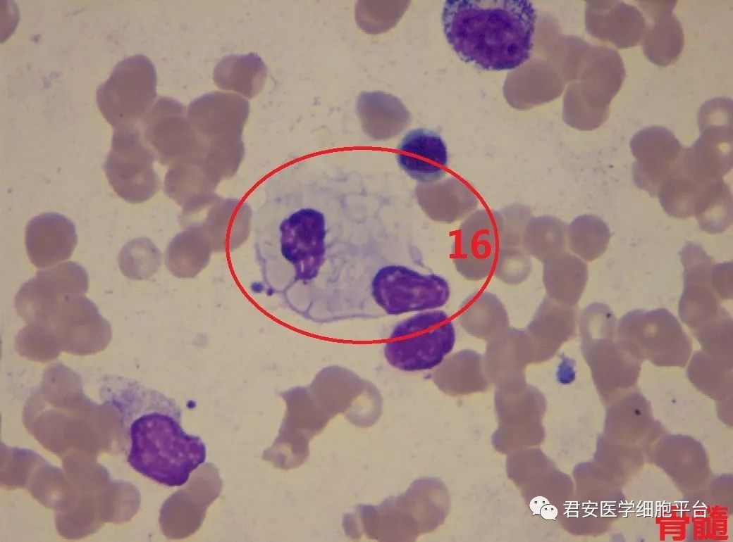 尼曼匹克细胞染色图片