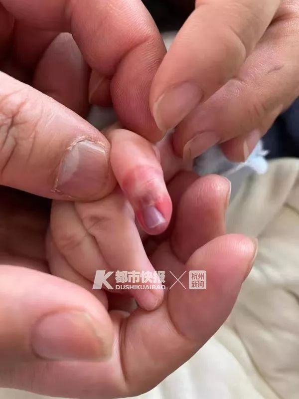 杭州5个月大宝宝因为一根橡皮筋,差点要截肢!