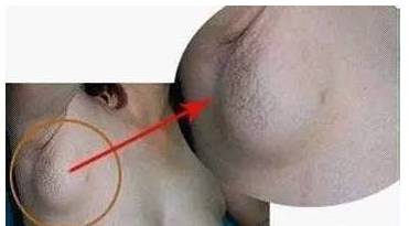 "副乳"是乳腺癌,淋巴癌的前奏!_乳房
