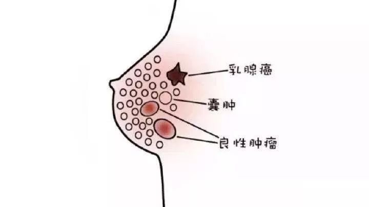 正常乳房结节图片图片