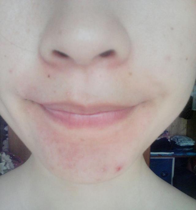 蔡少芬产第三胎脸上突发起痘痘原因何在