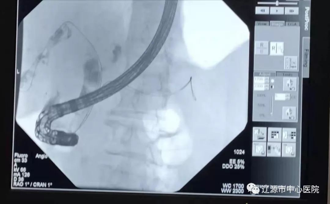 新技术内镜逆行性胰胆管造影术ercp
