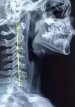 脖子骨头弯曲图片图片