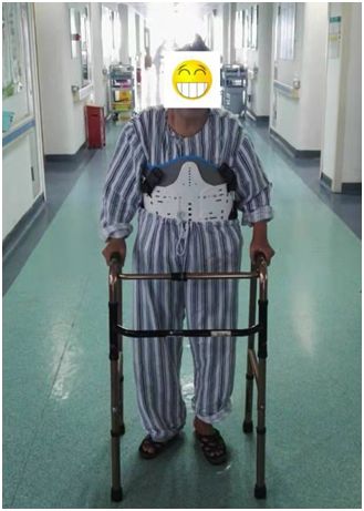 83岁阿婆腰椎爆裂骨折无法行走全因这种高发疾病