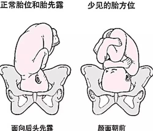 枕先露loa胎位图图片