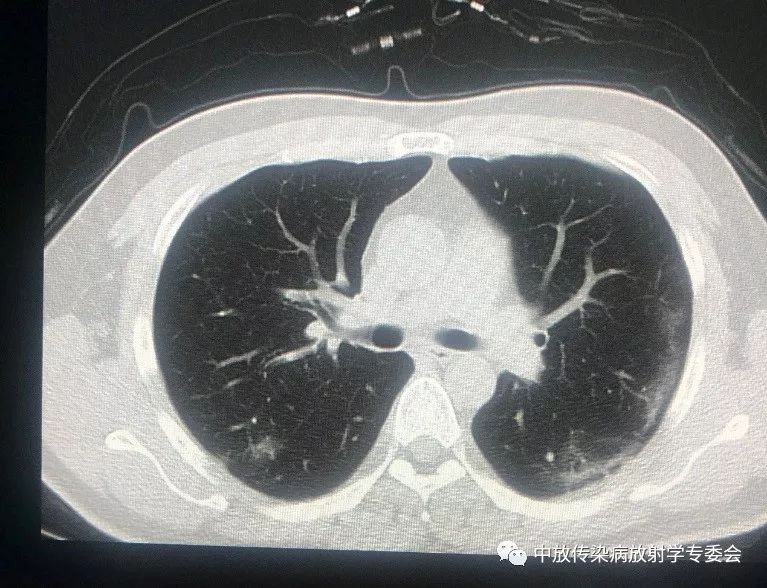 新冠肺炎肺部图片