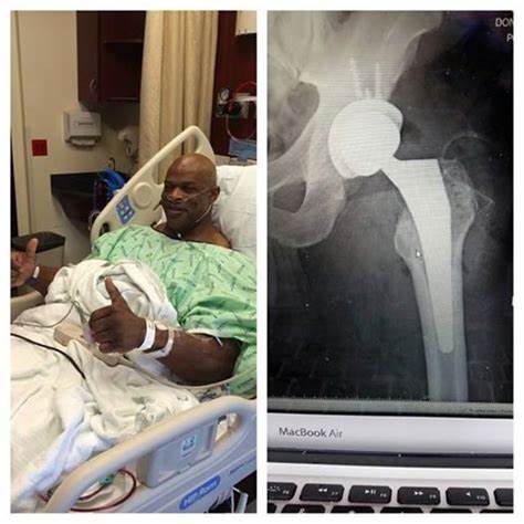 祖师爷罗尼科尔曼为最近一次手术成功完成